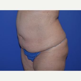 35-44 year old woman treated with No-Drain Tummy Tuck before 3649502