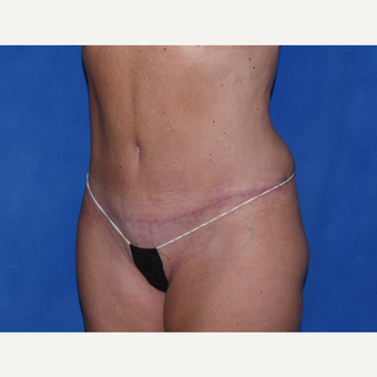 35-44 year old woman treated with No-Drain Tummy Tuck after 3649502