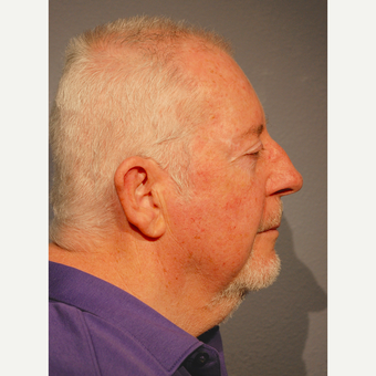 65-74 year old man treated with Neck Lift before 3770202