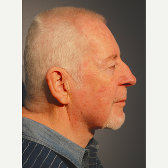 65-74 year old man treated with Neck Lift after 3770202