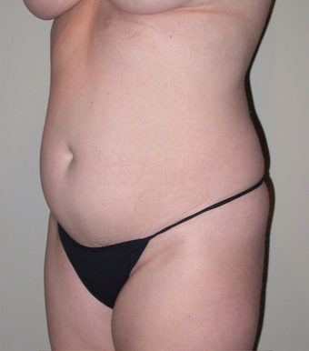 VASER liposelection before 295525