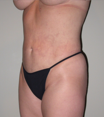 VASER liposelection after 295525