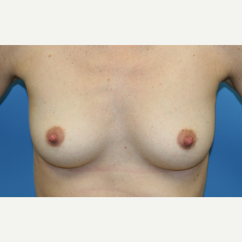 33 year old woman treated with Breast Augmentation before 3482620