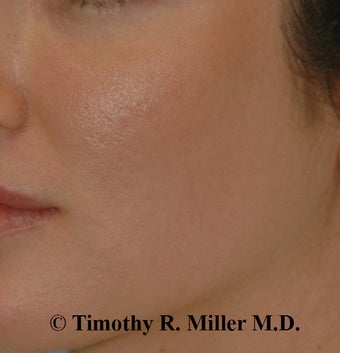 Acne scar Treatment after 1448482