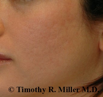 Acne scar Treatment before 1448482