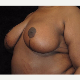 19 year old woman treated with Breast Lift after 3026048