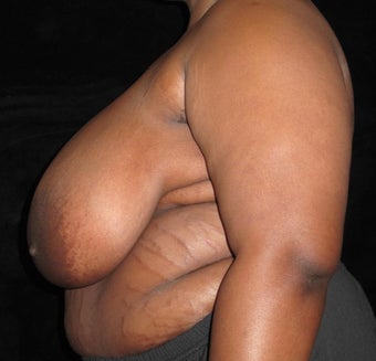 19 year old woman treated with Breast Lift 3026048