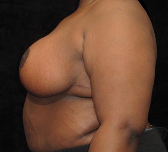 19 year old woman treated with Breast Lift 3026048