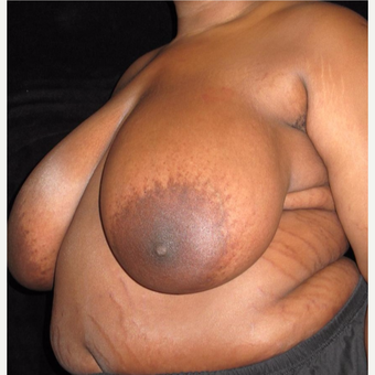 19 year old woman treated with Breast Lift before 3026048