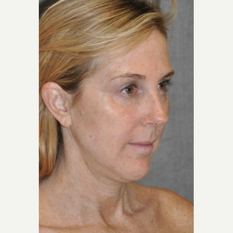 45-54 year old woman treated with Brow Lift before 3567167