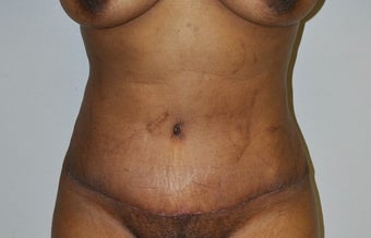 35-44 year old woman treated with Tummy Tuck after 2671951