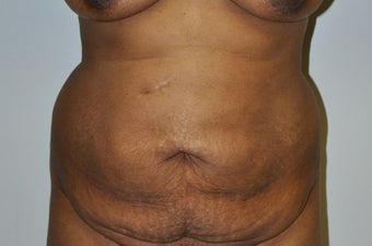 35-44 year old woman treated with Tummy Tuck before 2671951