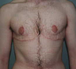 38-Year-Old Male Breast Reduction after 668354