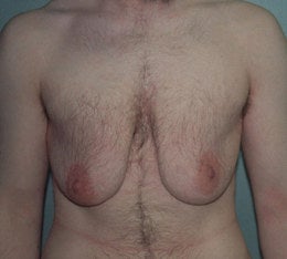 38-Year-Old Male Breast Reduction before 668354