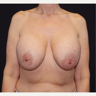 35-44 year old woman treated with Breast Implant Removal before 3741640