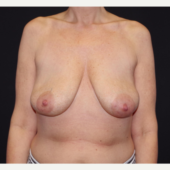 35-44 year old woman treated with Breast Implant Removal after 3741640