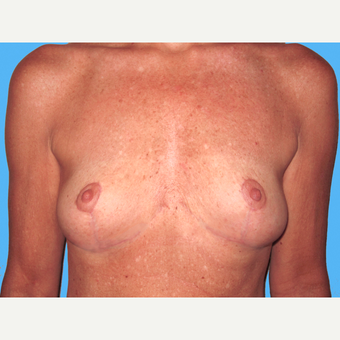 Breast Implant Removal after 3809798