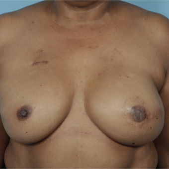 55-64 year old woman treated with Breast Reconstruction after 3729913