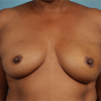 55-64 year old woman treated with Breast Reconstruction before 3729913