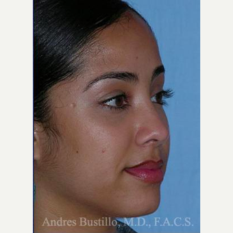 29 year old woman treated with Revision Rhinoplasty after 3460648
