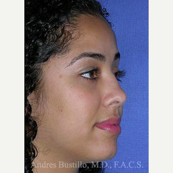 29 year old woman treated with Revision Rhinoplasty before 3460648