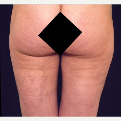 35 Year Old Female Liposuction Inner and Outer Thighs after 3093974