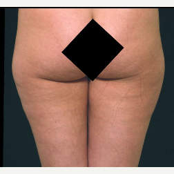 35 Year Old Female Liposuction Inner and Outer Thighs before 3093974