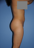 Buttocks Enhancement 296683