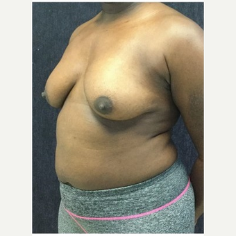 35-44 year old woman treated with Breast Lift with Implants before 3219410