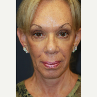 64 year old woman treated with Juvederm after 3689952