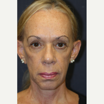64 year old woman treated with Juvederm before 3689952