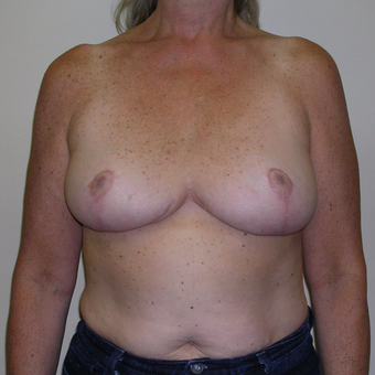 45-54 year old woman treated with Breast Reduction after 3000503
