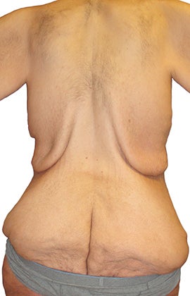 44 year old man treated with Body Lift 3409097