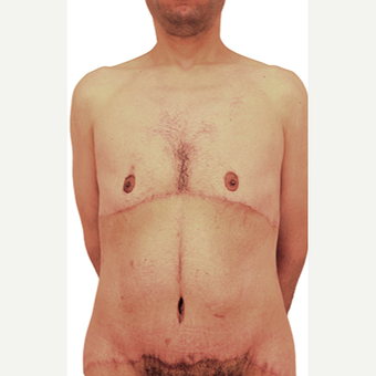 44 year old man treated with Body Lift after 3409097