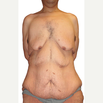 44 year old man treated with Body Lift before 3409097