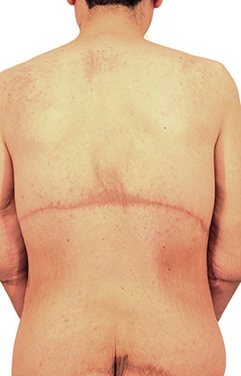 44 year old man treated with Body Lift 3409097
