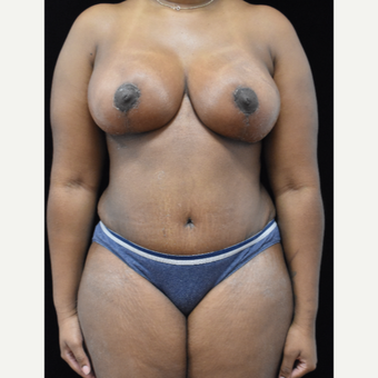 25-34 year old woman treated with Mommy Makeover after 3064824