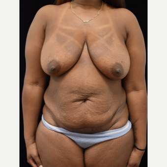25-34 year old woman treated with Mommy Makeover before 3064824