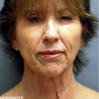 55-64 year old woman treated with Neck Lift before 2014438