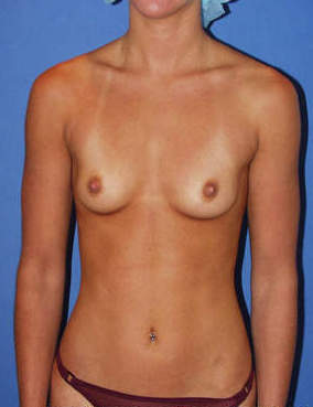 Breast Augmentation before 1411074