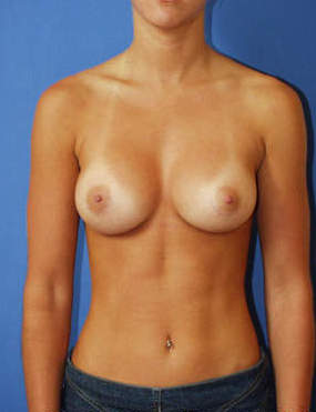 Breast Augmentation after 1411074