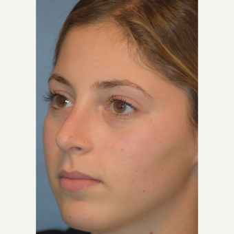 17 or under year old woman treated with Rhinoplasty after 3505821