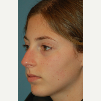 17 or under year old woman treated with Rhinoplasty before 3505821