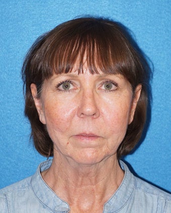 67 year old woman treated with Facelift 3576650