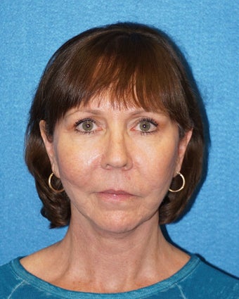67 year old woman treated with Facelift 3576650