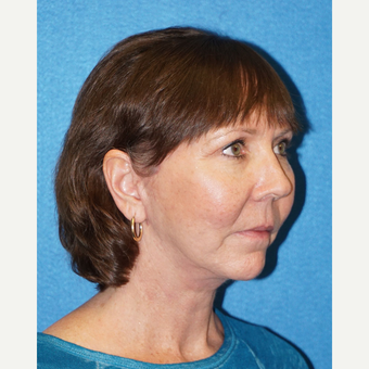 67 year old woman treated with Facelift after 3576650