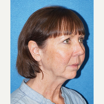 67 year old woman treated with Facelift before 3576650
