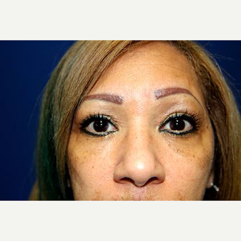 55-64 year old woman treated with Chemical Peel after 3093968