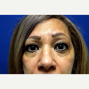 55-64 year old woman treated with Chemical Peel before 3093968