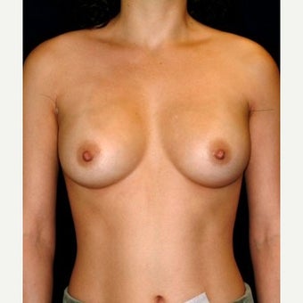 Transaxillary Augmentation Revision with Silicone Implant Conversion and Volume Decrease after 1550602